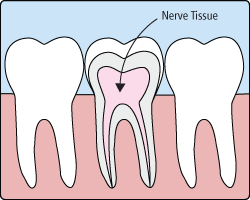 Root Canals Root Canals